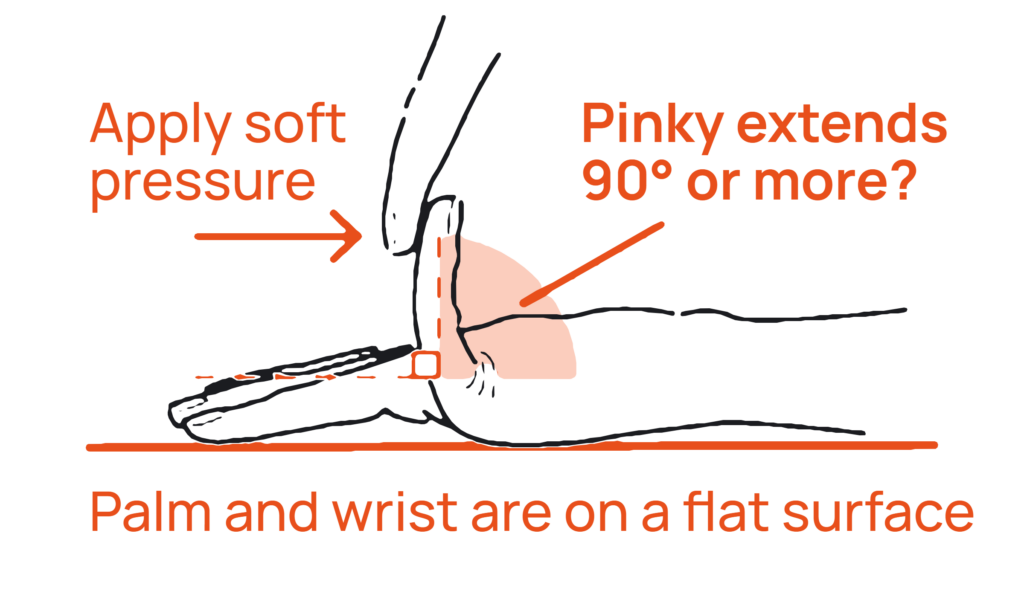 beighton score pinky test